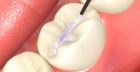 Герметизация фиссур 1-го зуба жидкотекучим композитом