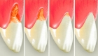 Лечение клиновидного  дефекта с использованием светоотверждаемого пломбировочного материала (CHARISMA, FILTEK, ESTELITE,GRADIA DIRECT) 1го зуба
