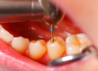 Лечение  глубокого кариеса с использованием светоотверждаемого пломбировочного  материала (CHARISMA ,FILTEK ,ESTELITE GRADIA DIRECT) 1го зуба