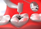 Лечение депульпированного зуба с использованием светоотверждаемого  пломбировочного материала(CHARISMA, FILTEK, ESTELITE,GRADIA DIRECT) 1го зуба
