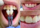 Частичное восстановление коронки фронтальных зубов (коронка разрушена наполовину) с использованием светоотверждаемого пломбировочного материала. (CHARISMA, FILTEK, ESTELITE,GRADIA DIRECT) 1го зуба