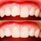 Полное восстановление коронки фронтальных зубов (депульпированных, коронка разрушена более, чем наполовину) с использованием светоотверждаемого пломбировочного материала. (CHARISMA. FILTEK, ESTELITE,GRADIA DIRECT) 1го зуба