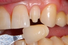 Восстановление зуба (культи)светоотверждаемый/жидкотекучий материал(в ассортименте) под искусственную коронку.