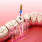 Лечение пульпита 3-х канального зуба с использованием лечебной прокладки  «Пульпотек»