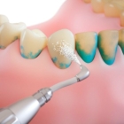 Снятие зубных  отложений  ультразвуком (две челюсти)
