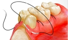 Наложение швов (в области одного зуба)