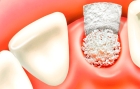 Использование костного биоматериала( в ассортименте) в области 1-го зуба