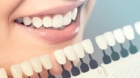 Косметическое отбеливание зубов 