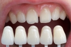 Керамические виниры на зубы 