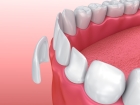 Керамические виниры на передние зубы 