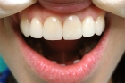 Диоксид циркония коронки на передние зубы 