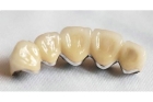 Металлокерамическая коронка  на передние нижние зубы