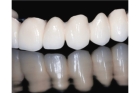 Коронка на зуб из диоксида циркония в стоматологии
