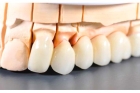 Коронки из диоксида циркония на передние нижние зубы