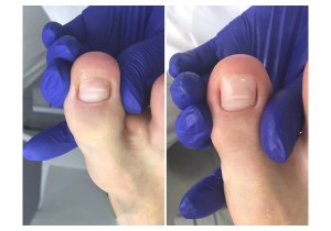 Протезирование ногтя
