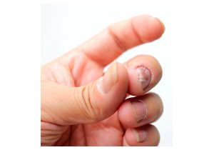 Лечение грибка ногтей на руках