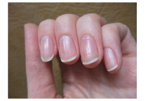 Лечение грибка ногтей на указательном пальце