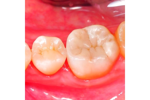 Лечение среднего кариеса с использованием светоотверждаемого пломбировочного  материала (CHARISMA, FILTEK, ESTELITE,GRADIA DIRECT) 1го зуба