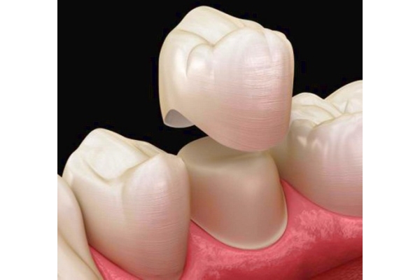 Частичное восстановление коронки жевательных зубов (коронка разрушена  наполовину) с использованием светоотверждаемого пломбировочного материала (CHARISMA. ,FILTEK, ESTELITE ,GRADIA DIRECT) 1го зуба