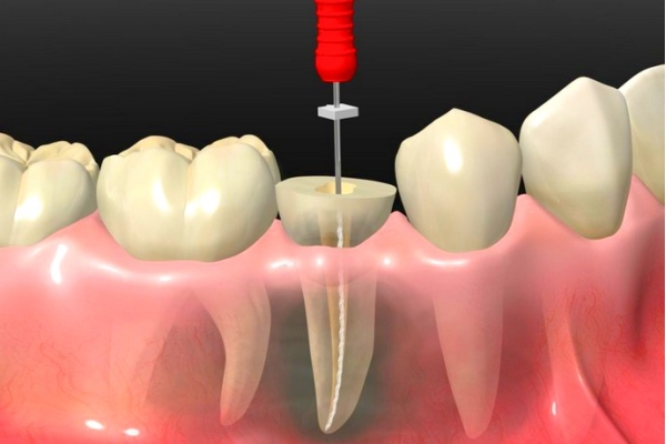 Лечение одноканального зуба (депульпация,мех. и  мед. обработка,обтурация  силером с использованием гуттаперчевых штифтов)