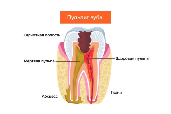 Лечение трёхканального зуба (депульпация,мех. и  мед. обработка,обтурация  силером с использованием гуттаперчевых штифтов)