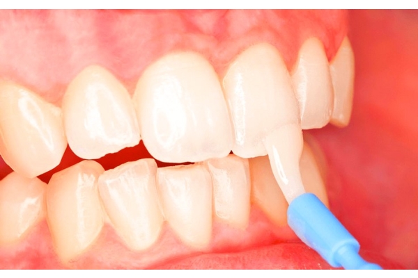 Реминерализующая терапия (обработка поверхности одного зуба кальцийсодержащими и фторсодержащими препаратами, в том числе  десенситайзерами)
