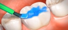 Герметизация устья канала жидкотекучим композитом 1го зуба	
