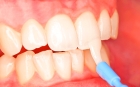 Реминерализующая терапия (обработка поверхности одного зуба кальцийсодержащими и фторсодержащими препаратами, в том числе  десенситайзерами)