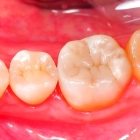 Лечение среднего кариеса с использованием светоотверждаемого пломбировочного  материала (CHARISMA, FILTEK, ESTELITE,GRADIA DIRECT) 1го зуба