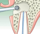 Лечение трёхканального зуба (распломбирование к/к, мех. и мед.  обработка,введение лек. средств, обтурация к/к силером с использованием  гуттаперчевых штифтов)