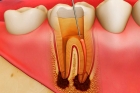 Лечение двухканального зуба (депульпация,мех. и  мед. обработка,обтурация  силером с использованием гуттаперчевых штифтов)