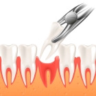 Удаление 1 подвижного зуба + анестезия