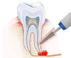 Резекция верхушки корня (1к зуба) (без использования костного материала)