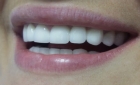 Циркониевая коронка на зуб 