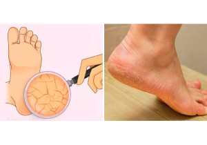 Лечение поверхностных трещин на ногах