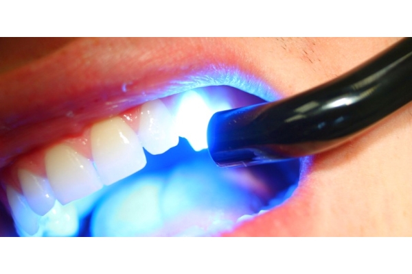 Лечение поверхностного кариеса с наложением композитных материалов светового отверждения (CHARISMA, FILTEK, ESTELITE, GRADIA DIRECT)*)1го зуба