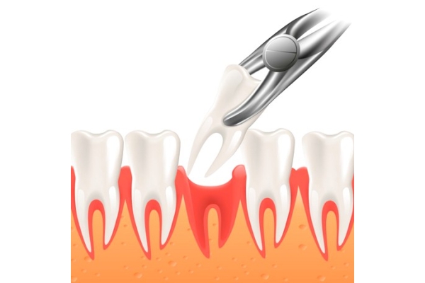 Удаление 1 подвижного зуба + анестезия